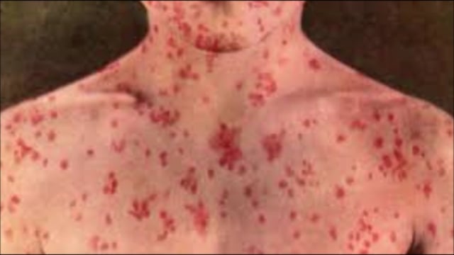 MEASLES OUTBREAK GETS BIGGER: More Cases In Williamsburg, Boro Park, Monsey, Lakewood