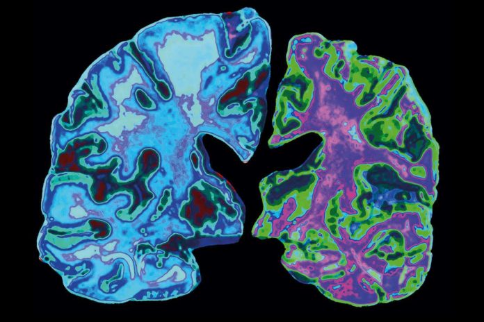 alzheimers